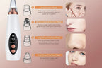 Extracteur de points noirs et aspirateur de pores – Extraction et nettoyage comme un pro